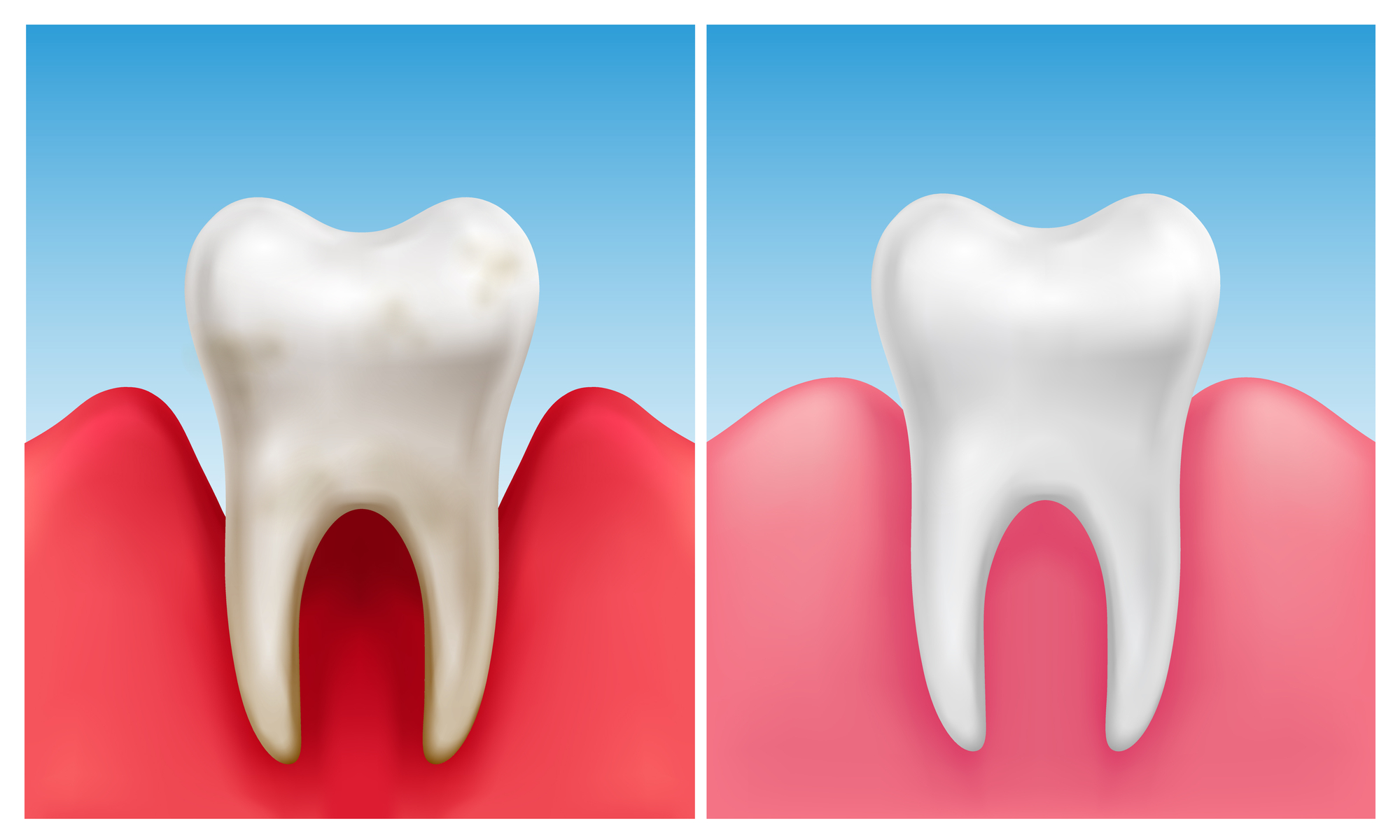 Defeat Periodontal Disease in 30 seconds