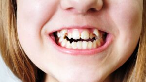 Crowded Teeth – When, Why, How